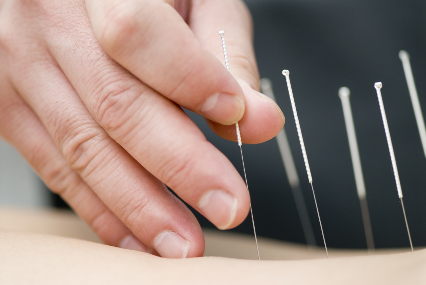 Dry Needling. Multiple Needles